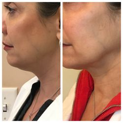 Bellevue Medispa - Kybella is great for the neck!