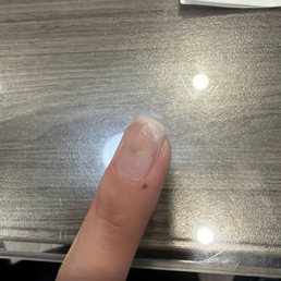 The fungus they caused my nails The fungus they caused my nails