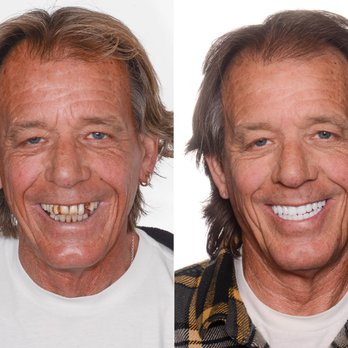 ArtLab Dentistry - John J. before & after full mouth reconstruction - Cosmetic Dentists Near Me - Woodland Hills, California ArtLab Dentistry - John J. before & after full mouth reconstruction - Cosmetic Dentists Near Me - Woodland Hills, California