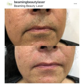 Beaming Beauty - Before and After - Upper lip - Laser Hair Removal Near Me - Miramar, Florida Beaming Beauty - Before and After - Upper lip - Laser Hair Removal Near Me - Miramar, Florida