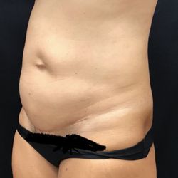 Honolulu Plastic Surgery - Thank you Dr.Wong for this tummy tuck!