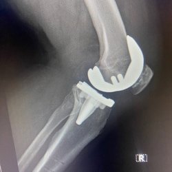 Sumit H Rana, MD - Robotic-assisted Total Knee Replacement Right knee, outpatient