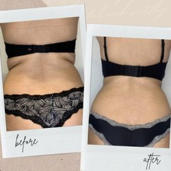 Body Shaping Center - Laser lipo for bra rolls