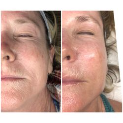 Savvy Skin Spa - Before & after of Beauty Bomb resulting in smoother toned skin.