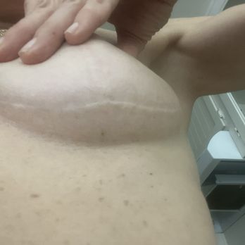 Lanoi Dermatology - Nine months after Dr. Rudy burned my skin with a laser because he didn't know what he was doing - Dermatologists Near Me - San Diego, California Lanoi Dermatology - Nine months after Dr. Rudy burned my skin with a laser because he didn't know what he was doing - Dermatologists Near Me - San Diego, California