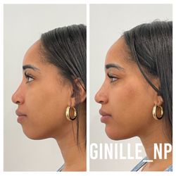 Ginille Beauty Aesthetics - Cheeks and chin filler