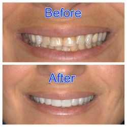 Davis Dentistry - Upper Veneers