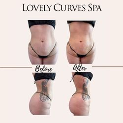 Lovely Curves Spa - Before & After Lymphatic Drainage massage
