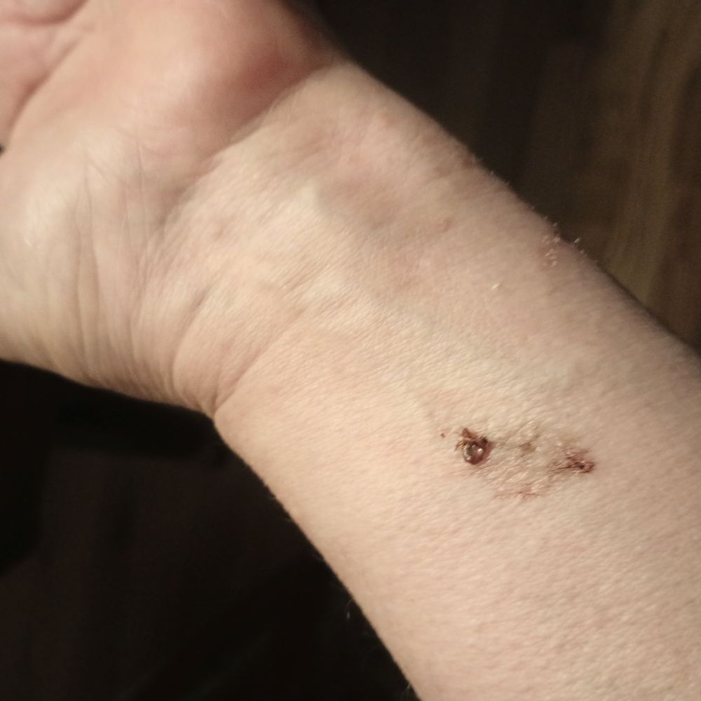 Goodwin Cleaning And Pest Control - Bed bug bit me and I killed it on my arm. - Pest Control Near Me