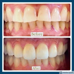 Pearl Smiles Dental - Veneers.
Happy patient
Cosmetic Dentist
Straight teeth