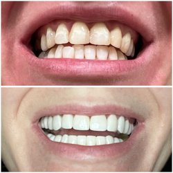 Haven Dental - Side by side of my (mostly) completed veneers. Waiting on an implant crown in the back and it will be completely done.