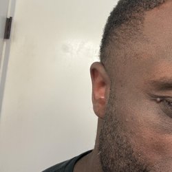 Los Angeles Skin Care - Skin Tag In The Corner Of The Eye.