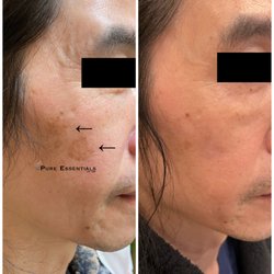 Pure Essentials - Age / Sun Spot Removal. Left photo: removed two large skin growths on right cheek Feb '22. Right photo: after photo taken by client Feb '23
