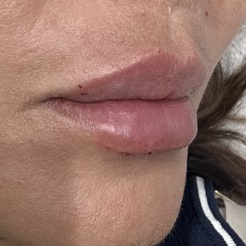 RegenerateMe - Lip filler by Zarah - Medical Spas Near Me - Las Vegas, Nevada