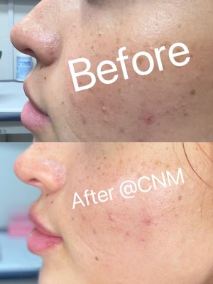 Lip Filler - Before & afters Lip Filler - Before & afters