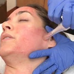 Sereno Aesthetics - Microneedling