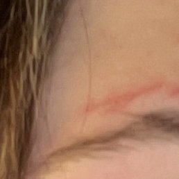 More pictures of the burns