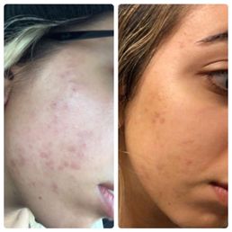 Before and After Before and After