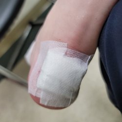 Las Vegas Skin & Cancer Clinics Buffalo - Bandage after cyst removal on foot heel. Have stitches too that will be removed in 2 weeks.
