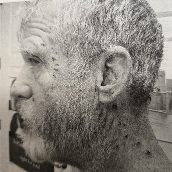 Barton Urgent Care - clearly bites  neck, around eyes, swelling the face and lymphatic system - Urgent Care Near Me - Stateline, Nevada
