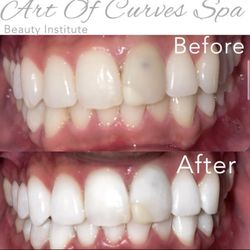 Before and after of my teeth. My tooth needs to be replaced since it's dead, but they made it come back to life with the whitening!