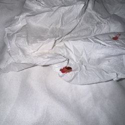 Comfort Inn & Suites Chipley I-10 - Smashed bed bugs