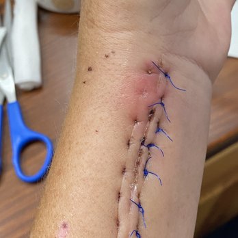 Midlands Orthopaedics & Neurosurgery - 24 hours after previous picture you can see it spreading rapidly - Surgeons Near Me - Lexington, South Carolina Midlands Orthopaedics & Neurosurgery - 24 hours after previous picture you can see it spreading rapidly - Surgeons Near Me - Lexington, South Carolina