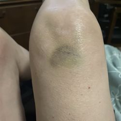 Metropolitan Methodist Emergency Center At the Quarry - Bruised knee.