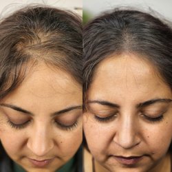 Scalpp Clinic - Scalp Micropigmentation for Women Female Hairloss Solution in Houston Texas Scalp Microblading