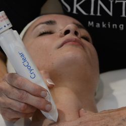 Skinticians - Cryotherapy. Remove skin tags and brown spots.