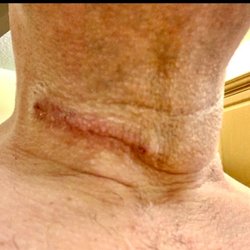 Anthony N Dardano, DO, FACS - From re-doing a less than 1 inch incision. 1 day after his surgery.
