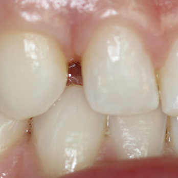 Christopher M Herman, DDS - Actual Patient Before Bonding Procedure - Cosmetic Dentists Near Me - Oceanside, California Christopher M Herman, DDS - Actual Patient Before Bonding Procedure - Cosmetic Dentists Near Me - Oceanside, California