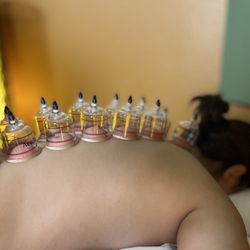Shanti Spa - Cupping helps improve blood flow and reduce pain.