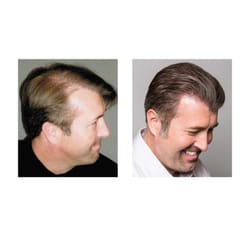 Bosley Hair Restoration & Transplant