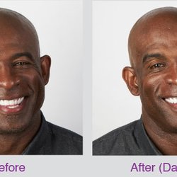 About You - Personal Aesthetics - Have you heard the big news? Deion "Prime Time" Sanders has been treated with BOTOX® Cosmetic.