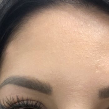 Gateway Medspa - One eyebrow higher than the other due to bad Botox from gateway med spa in Eastvale ca - Medical Spas Near Me - Eastvale, California