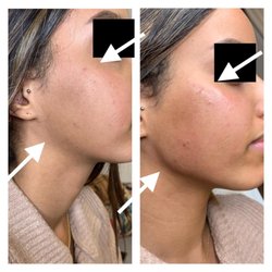 Sebastian Rose Medical Aesthetics - Cheek jaw filler