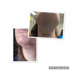 Vermont Laser and Electrology - Laser hair removal!