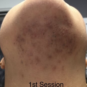 Laser Remedy MedSpa - 1st Session 6/10/19 - Laser Hair Removal Near Me - Philadelphia, Pennsylvania Laser Remedy MedSpa - 1st Session 6/10/19 - Laser Hair Removal Near Me - Philadelphia, Pennsylvania