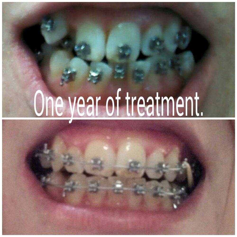 Alexander Orthodontics - My progress. Huge difference in one year. I Started seeing Dr. Bartlet in Feb. 2014 to Feb. 2015 - Orthodontists Near Me - Queensbury, New York Alexander Orthodontics - My progress. Huge difference in one year. I Started seeing Dr. Bartlet in Feb. 2014 to Feb. 2015 - Orthodontists Near Me - Queensbury, New York