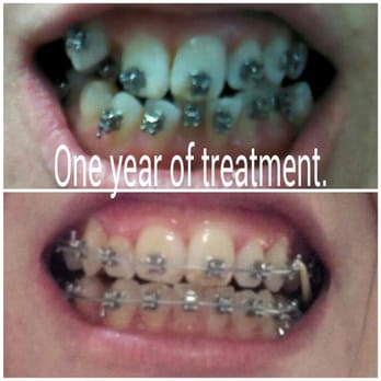 Alexander Orthodontics - My progress. Huge difference in one year. I Started seeing Dr. Bartlet in Feb. 2014 to Feb. 2015 - Orthodontists Near Me - Queensbury, New York Alexander Orthodontics - My progress. Huge difference in one year. I Started seeing Dr. Bartlet in Feb. 2014 to Feb. 2015 - Orthodontists Near Me - Queensbury, New York