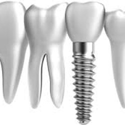 Steven C Stacey, DDS - Have a missing tooth? Call us today for a dental implant consultation !
