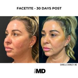 SkinMD Peabody - 30 days and a world of difference with FaceTite at Skin MD.
