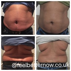 Feel Better Now - Before and after 4 sessions of Vacuum Therapy. email to info@feelbetternow.co.uk to get our promotion