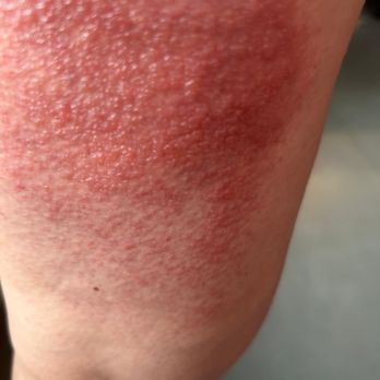 Le Negresco - bacterial infection on leg from hammam/steam shower - Hotels Near Me - Nice, 06