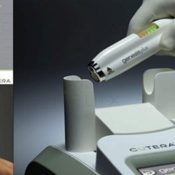 Cutera Genesis Plus Laser Treatment for Nail Fungus