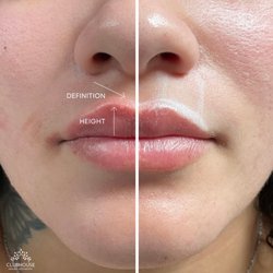 ClubHouse Skin and Laser Medspa - LIP FILLER HALFWAY POINT