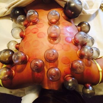 Cupping4Life - Getting toxins out!!! - Massage Near Me - San Diego, California