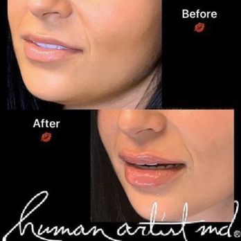 Adam Mauer, MD - Lips - Dermatologists Near Me - New York, New York