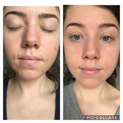 Denver Healthy Skin & Acne Clinic